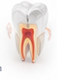 Root Canal Treatment illustration
